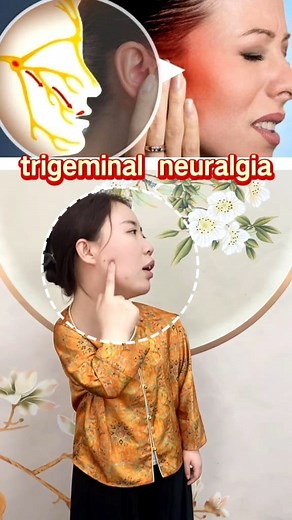 三叉神经痛 #trigeminalneuralgia #三叉神经痛 #fyp #tcm #穴位 #中医 | Dr. Taichi