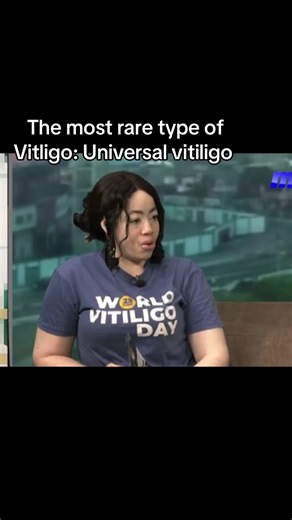 Universal Vitiligo: Signs, Causes, and Awareness