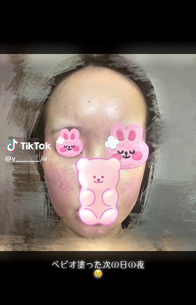 べピオローション使用体験：赤み、かゆみ、腫れ、化粧品アレルギーなし