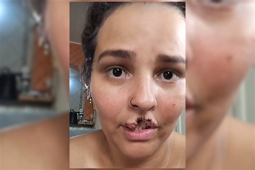Saiba destino de cachorro chow-chow que arrancou lábio de mulher