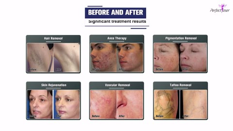 Watch Professional High Power ND YAG IPL Laser Device For Skin Restoration, Face Treatments, And Body Hair Tattoo Removal in Action | Exclusive on on DHgate