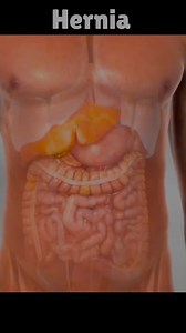 Hernia Repair 3D Animation Video #doctor #documentaryphotography #DoctorWho # reel # shorts #DoctorWh# | SMART Doctor