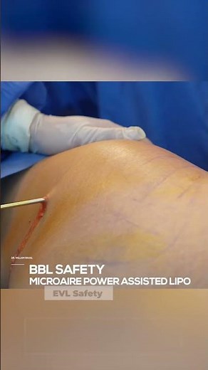 How to safely inject fat during a BBL! #plasticsurgery #shorts #bbl #liposuction #tummytuck