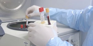 YOUR HEALTH: Revolutionary cellular therapy for melanoma