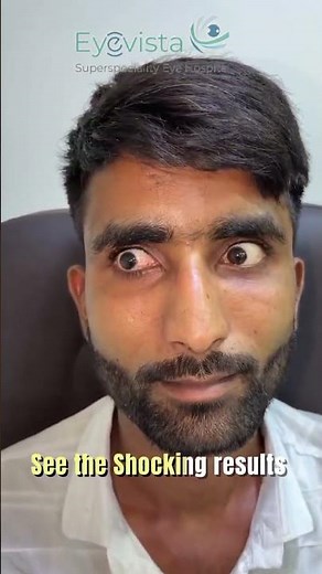 Complex Large-Angle V-Pattern Exotropia Corrected in One Surgery | Dr Ankit Shah