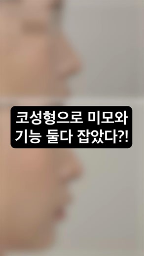 코성형으로 미모와 기능 둘다 잡았다?! #코성형후기 #코성형전후 #비염수술 #기능코성형