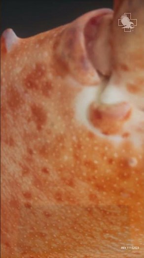 What is the Difference Between Kaolin and Chitosan in Hemostatics? #bethedifference #stopthebleed