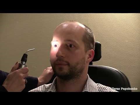 Assessment of Relative Afferent Pupillary Defect (RAPD)