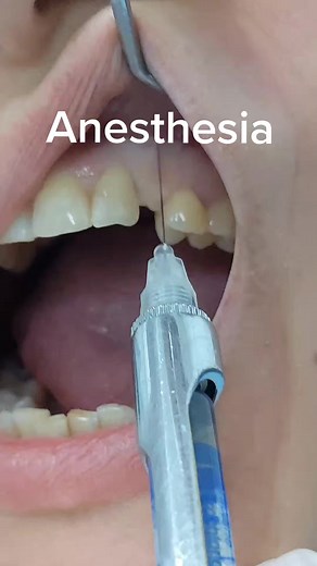 Anesthesia before surgery #anesthetic #dentalimplant #implant #dentist