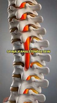 👉 Spinalkanalstenose Symptome & 3 Übungen, die sofort helfen!