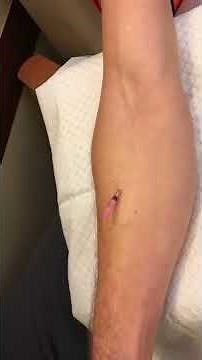 How To Start IVs @intravenousqueen