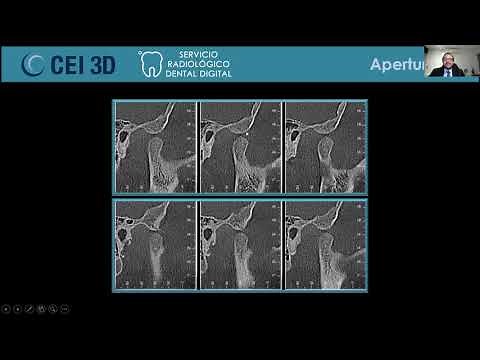 Interpretacion de la ATM en tomografía