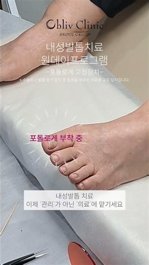 내성발톱치료 원데이 프로그램 - 오블리브 서울 오리진의원 #내성발톱관리 #내성발톱교정