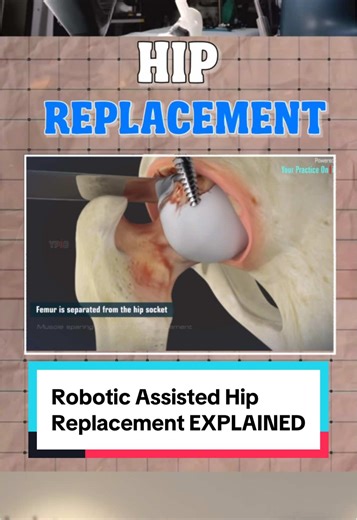 Robotic Assisted Hip Replacement Explained by Dr. McCormack