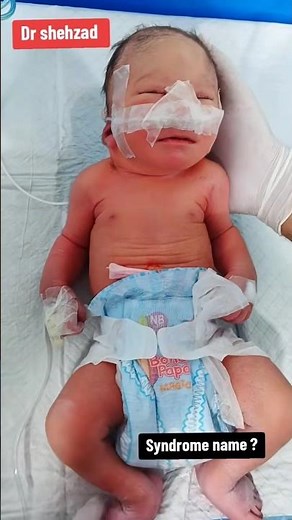 Baby Diagnosed with Edwards Syndrome (Trisomy 18) | Medical Insight & Care Journey