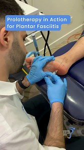Watch our podiatrist Emmanuel, in action as he performs Prolotherapy for plantar fasciitis! This innovative treatment helps stimulate healing and alleviate heel pain. If you're struggling with plantar fasciitis, come visit us at Adelaide Heel Pain Clinic to explore all the treatment options available. Let’s get you back on your feet!👣 #sports #nails #bunions #heel #footlink #adelaidebusiness #adelaidehealth #southaustralia #heelpain #adelaidemums #adelaidehills #heelpainrelief #podiatrist #prol