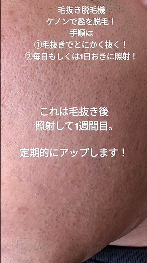 毛抜き脱毛機 ケノンの効果を実証！ 髭脱毛7日目