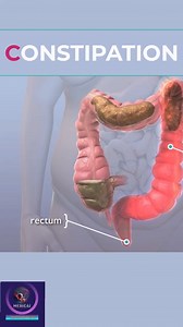 Constipation is often due to inadequate intake of dietary fiber and fluid, #constipation #medical #animation #foryouシ | Medical Animation Media