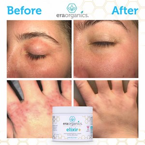 Anti-Itch cream - Calming skin rash cream - Eraorganics.com