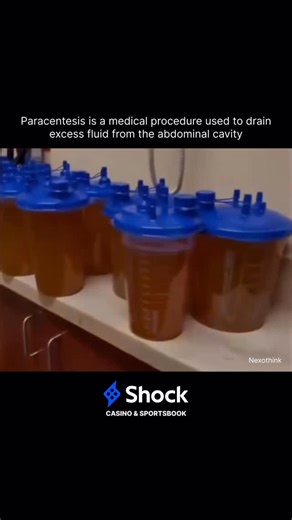 N E X O | Paracentesis is a medical procedure that involves draining excess fluid (ascites) from the abdominal cavity, primarily for diagnostic or... | Instagram