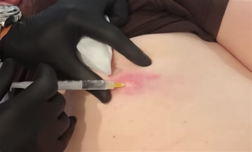 Inflamed Back Cyst Incision and Drainage