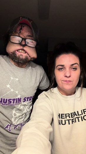 Justin's Rare Disease: CEP & Facial Reconstruction Explained