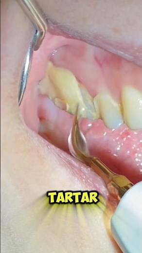 Your Toothbrush Can’t Remove Tartar!😱