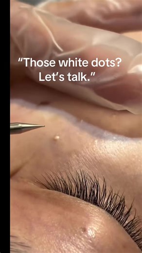 Understanding Milia: Causes and Solutions