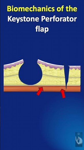Shorts # 147: The Keystone perforator flap - What are the ways in which this flap can move?