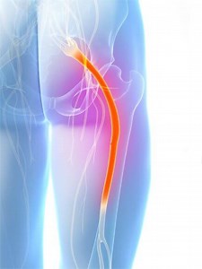 Sciatica: Causes, Symptoms, and Treatments