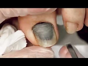 Relaxing Toenail Care | Gentle Cleaning & Nail Recovery