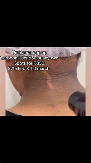 Unlock Radiant Skin with Carbon Laser Treatment