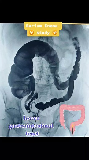 ‏💯👌 #x_ray #medicine #medical #colon #barium #radiology