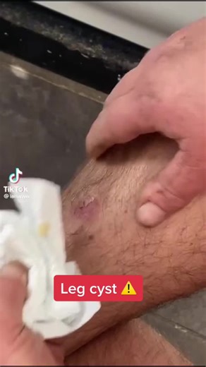 First Aid for Knee Wounds: Treating a Leg Cyst