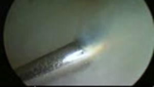 Arthroscopic TFCC repair - Low Definition