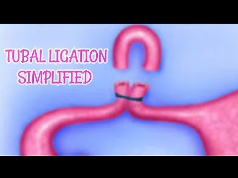 Bilateral Tubal Ligation Simplified