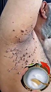 Remove warts permanently at home #wart #natural #healthtips #reels | Natural Beauty Recipes