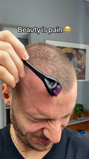 Rooty | Balding is going crazy… | Instagram