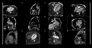 Real-time Mri Footage Healthy Human Heart Stock Footage Video (100% Royalty-free) 3622838907 | Shutterstock