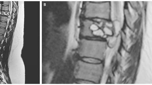 Woman with ‘electric shocks’ in legs ends up having tapeworm larvae wriggling in spine