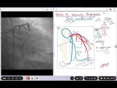 Coronary Angiogram. RAO caudal view.