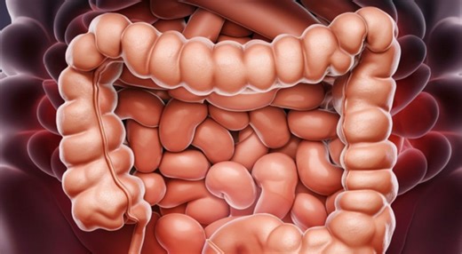 Cáncer de colon: etapas y qué tan mortal es