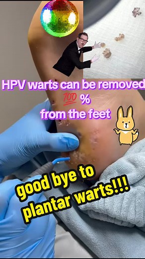 Effective Plantar Wart Removal in Just 2 Sessions