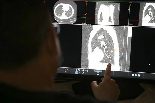 Lung cancer remains among top killers in PH | ABS-CBN News