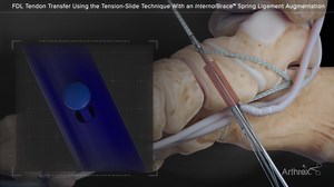 FDL Tendon Transfer Using Tension-Slide Technique and InternalBrace™ Spring Ligament Augmentation