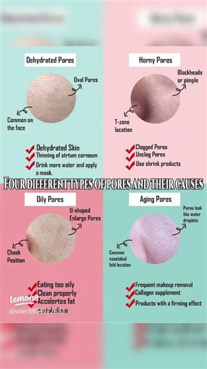 Four Types of Open Pores and their Causes | Know Your Types Open Pores and Solution #openpores