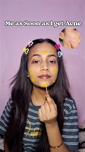 How I Get Rid Of My Acne Scars