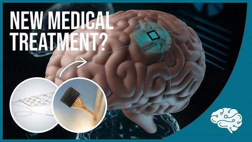 Brain Implants are Here: Blackrock’s Neuroport & Synchron’s Stentrode – Lifeboat News: The Blog