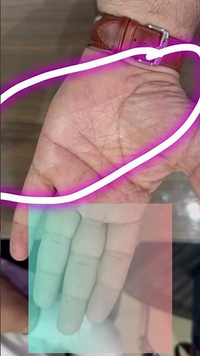 Fixomull #Adhesive #dressing ,multiple use, #safe, #secure and offers better #woundhealing #patient
