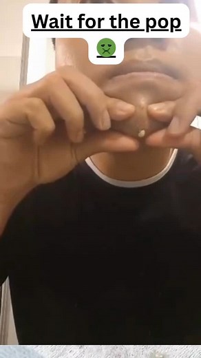 Best Pimple/Acne Videos on Instagram